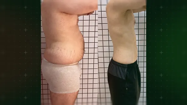 Antes e Depois